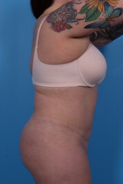 Extended Tummy Tuck Before & After Patient #6290