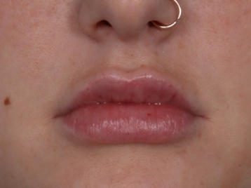 Lip Enhancement Before & After Patient #6307