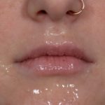 Lip Enhancement Before & After Patient #6307