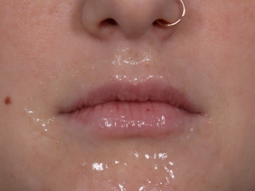 Lip Enhancement Before & After Patient #6307