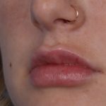 Lip Enhancement Before & After Patient #6307