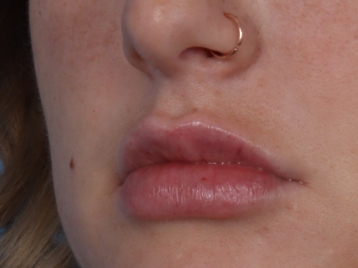 Lip Enhancement Before & After Patient #6307