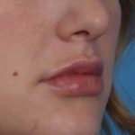 Lip Enhancement Before & After Patient #6307
