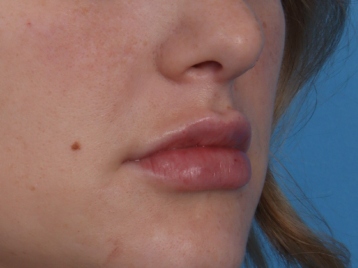 Lip Enhancement Before & After Patient #6307