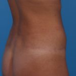 Tummy Tuck Before & After Patient #6314