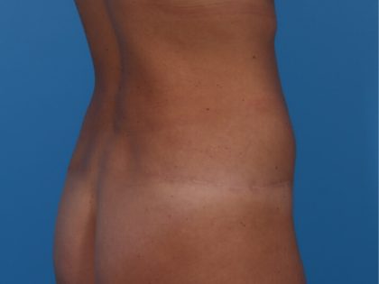 Tummy Tuck Before & After Patient #6314