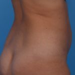 Tummy Tuck Before & After Patient #6314