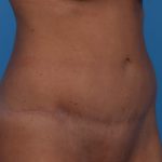 Tummy Tuck Before & After Patient #6314