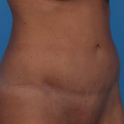 Tummy Tuck Before & After Patient #6314