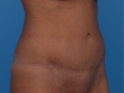 Tummy Tuck Before & After Patient #6314