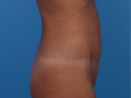 Tummy Tuck Before & After Patient #6314