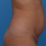 Tummy Tuck Before & After Patient #6314