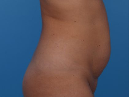 Tummy Tuck Before & After Patient #6314