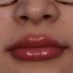 Lip Enhancement Before & After Patient #6322