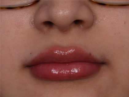 Lip Enhancement Before & After Patient #6322