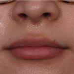 Lip Enhancement Before & After Patient #6322