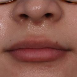 Lip Enhancement Before & After Patient #6322
