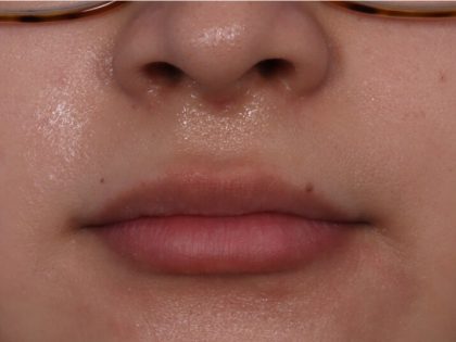 Lip Enhancement Before & After Patient #6322