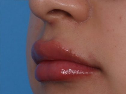 Lip Enhancement Before & After Patient #6322