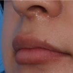 Lip Enhancement Before & After Patient #6322