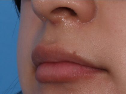 Lip Enhancement Before & After Patient #6322