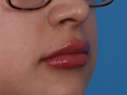 Lip Enhancement Before & After Patient #6322