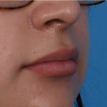 Lip Enhancement Before & After Patient #6322