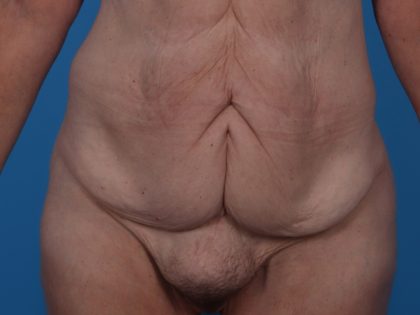 Tummy Tuck Before & After Patient #6457