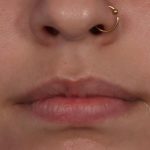 Lip Filler Before & After Patient #6606