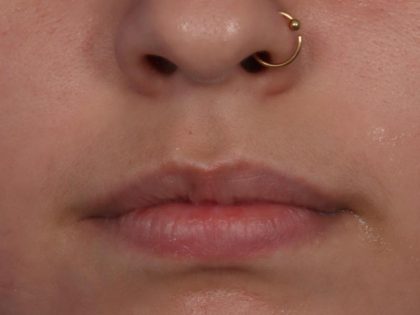 Lip Filler Before & After Patient #6606