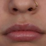 Lip Filler Before & After Patient #6606