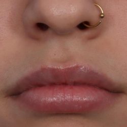 Lip Filler Before & After Patient #6606