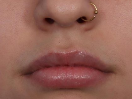 Lip Filler Before & After Patient #6606