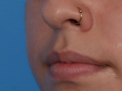 Lip Filler Before & After Patient #6606