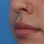 Lip Filler Before & After Patient #6606
