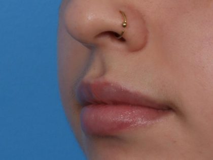 Lip Filler Before & After Patient #6606