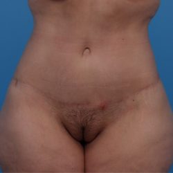 Lower Body Lift Before & After Patient #6642
