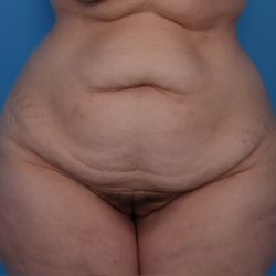 Lower Body Lift Before & After Patient #6642