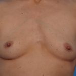 Breast Augmentation Before & After Patient #6834