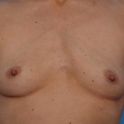 Breast Augmentation Before & After Patient #6834