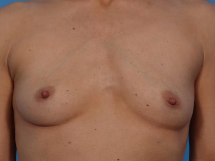 Breast Augmentation Before & After Patient #6834