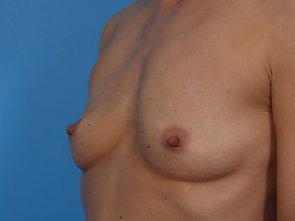 Breast Augmentation Before & After Patient #6834
