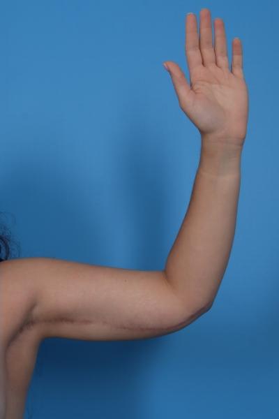 Arm Lift Before & After Patient #6872