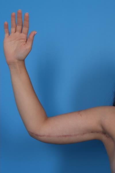 Arm Lift Before & After Patient #6872