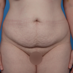 Extended Tummy Tuck Before & After Patient #6890