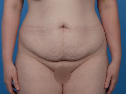 Extended Tummy Tuck Before & After Patient #6890