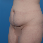 Extended Tummy Tuck Before & After Patient #6890