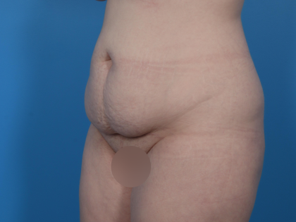 Extended Tummy Tuck Before & After Patient #6890