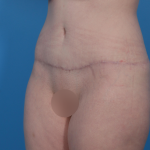 Extended Tummy Tuck Before & After Patient #6890