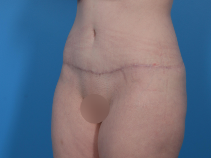 Extended Tummy Tuck Before & After Patient #6890